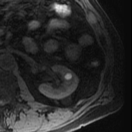 Atypical renal cyst on MRI | Image | Radiopaedia.org