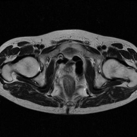 Congenital vascular malformation in the true pelvis | Radiology Case ...