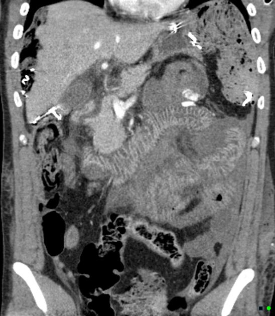 Shock bowel | Radiology Reference Article | Radiopaedia.org