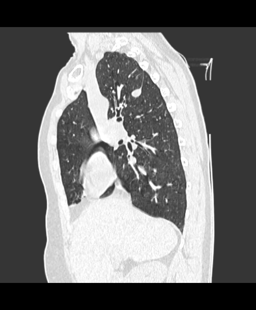 Azygos fissure and azygos lobe | Image | Radiopaedia.org