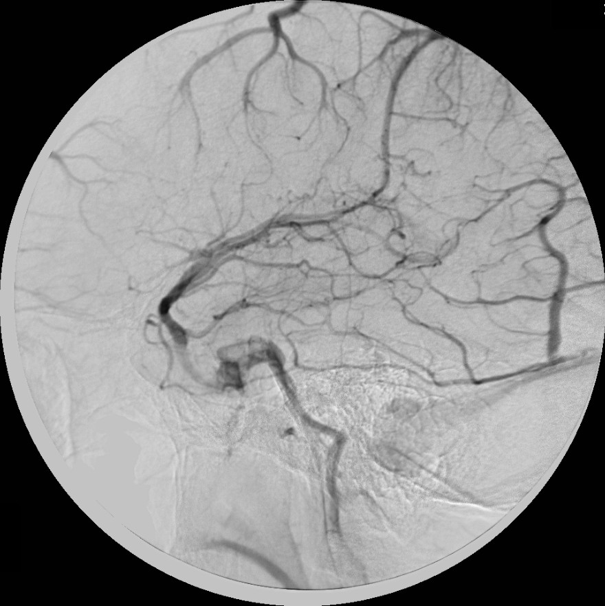 Ювенильная ангиофиброма основания черепа. Cerebral Angiography. Вирсунгоррагия.