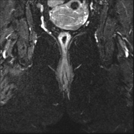 Normal pelvic MRI (fistula protocol) | Image | Radiopaedia.org