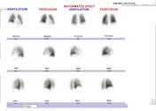 V Q Scan Radiology Reference Article Radiopaedia Org