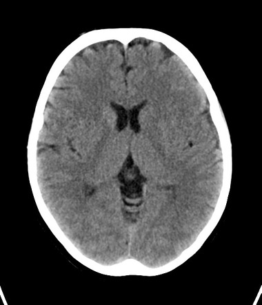 Takayasu's disease | Radiology Case | Radiopaedia.org