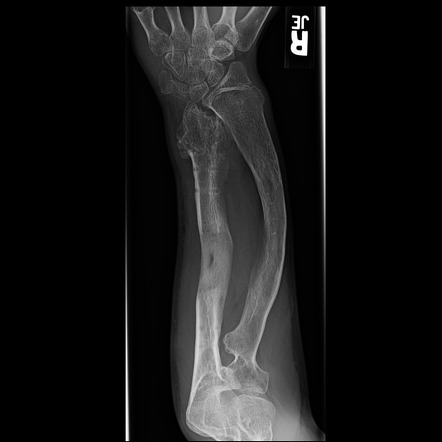 Hereditary multiple exostoses with Madelung deformity and ulnar ...