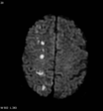 Watershed infarct | Radiology Case | Radiopaedia.org