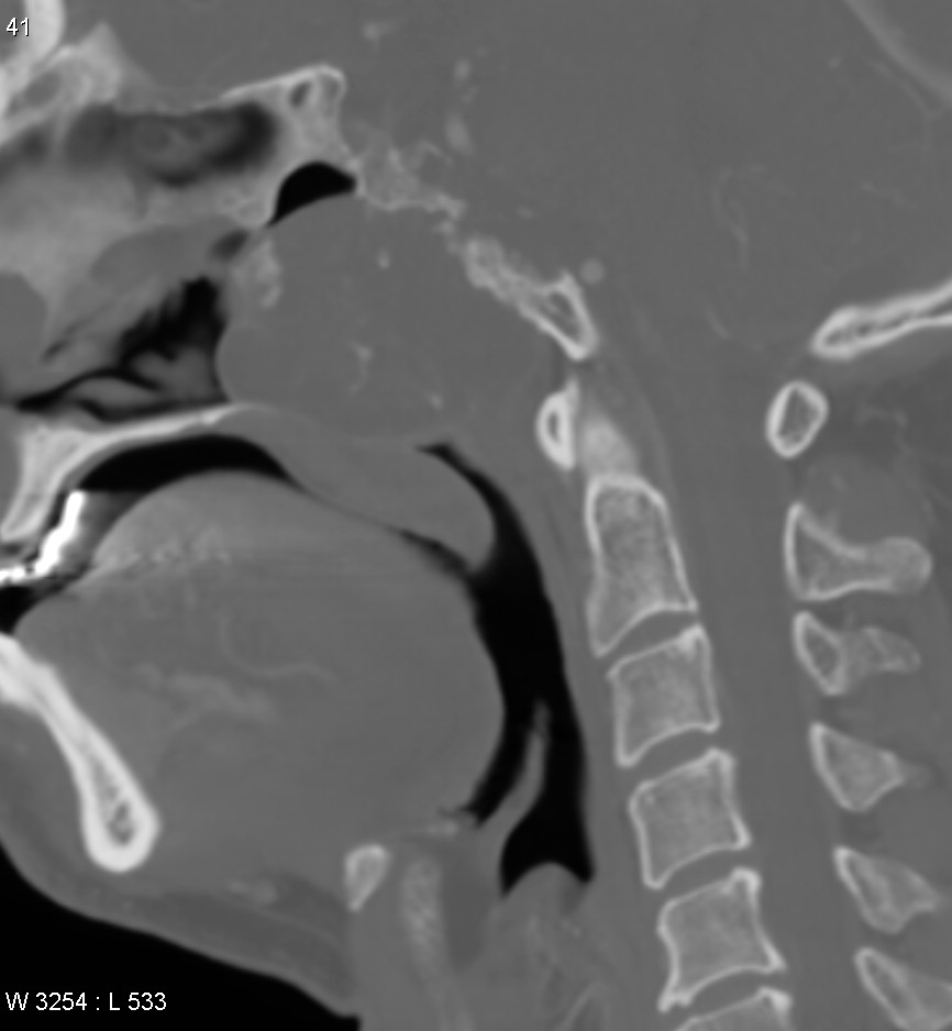 Chordoma - Clivus | Image | Radiopaedia.org