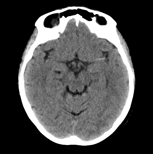 Left Mca Stroke Dense Mca Sign Image