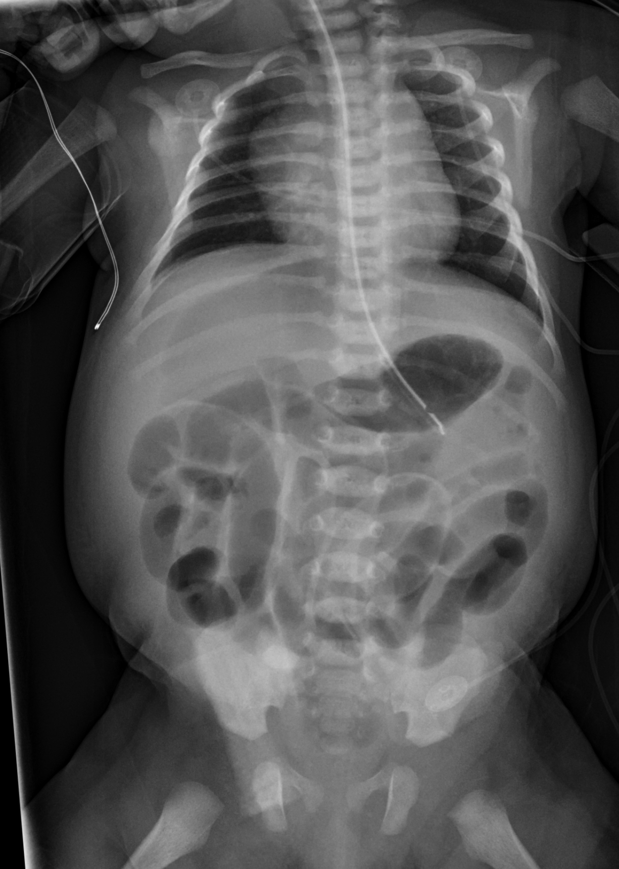 Neonatal Gastric Perforation Image