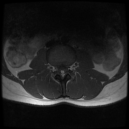 Christmas tree neurogenic bladder | Image | Radiopaedia.org