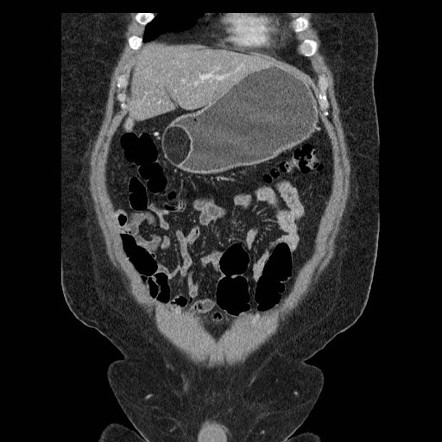 Gastric antral submucosal lipoma | Radiology Case | Radiopaedia.org