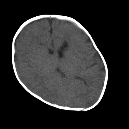 Posterior positional plagiocephaly | Radiology Case | Radiopaedia.org