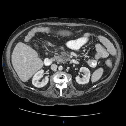 Superior mesenteric vein thrombosis | Radiology Case | Radiopaedia.org