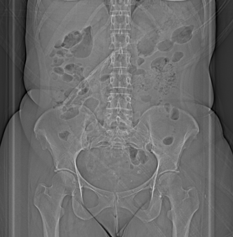 Intestinal Malrotation | Image | Radiopaedia.org