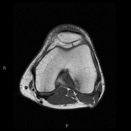 Intraosseus ganglion | Image | Radiopaedia.org