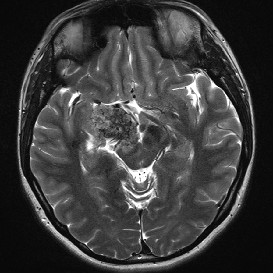 Chondrosarcoma | Image | Radiopaedia.org