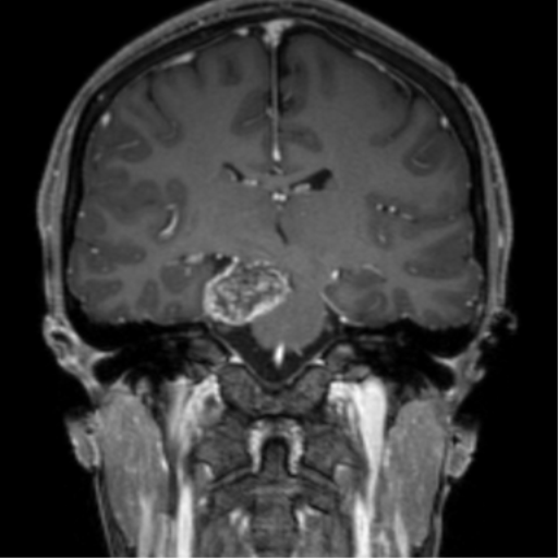 Chondrosarcoma | Image | Radiopaedia.org