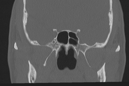 Normal CT paranasal sinuses | Radiology Case | Radiopaedia.org