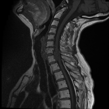 Spinal meningioma | Image | Radiopaedia.org