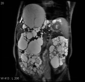 Autosomal dominant polycystic kidney disease, Radiology Reference Article