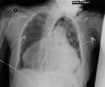 Gastric volvulus | Radiology Reference Article | Radiopaedia.org