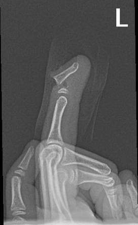 Seymour fracture | Radiology Reference Article | Radiopaedia.org