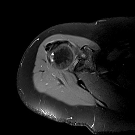 Calcific Tendinopathy Of The Rotator Cuff Image Radiopaedia Org