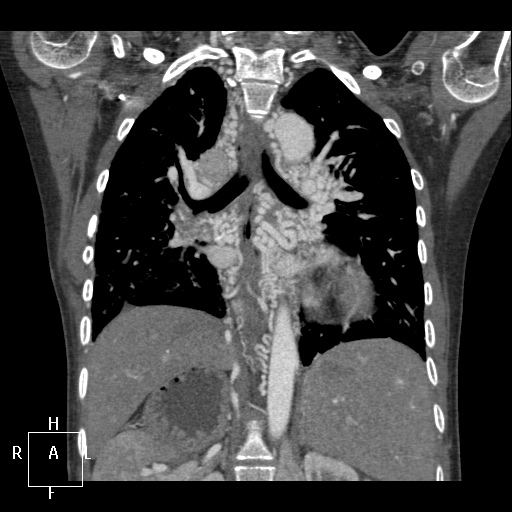 Heterotaxy syndrome | Image | Radiopaedia.org