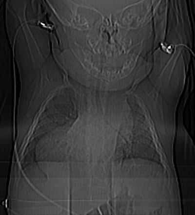 Heterotaxy syndrome (dextrocardia, atrioventricular discordance ...