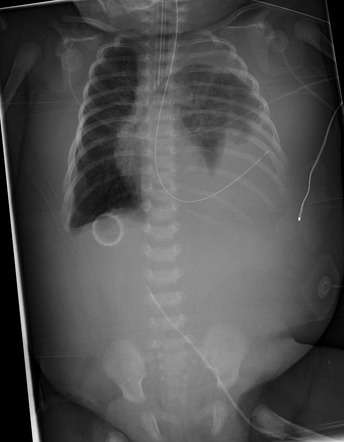 Congenital diaphragmatic hernia | Radiology Case | Radiopaedia.org