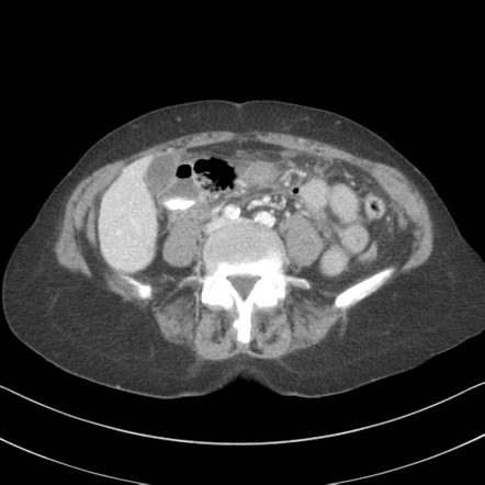 Duodenal diverticulum | Radiology Reference Article | Radiopaedia.org