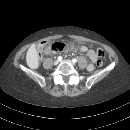 Perforated duodenal diverticulum | Radiology Case | Radiopaedia.org