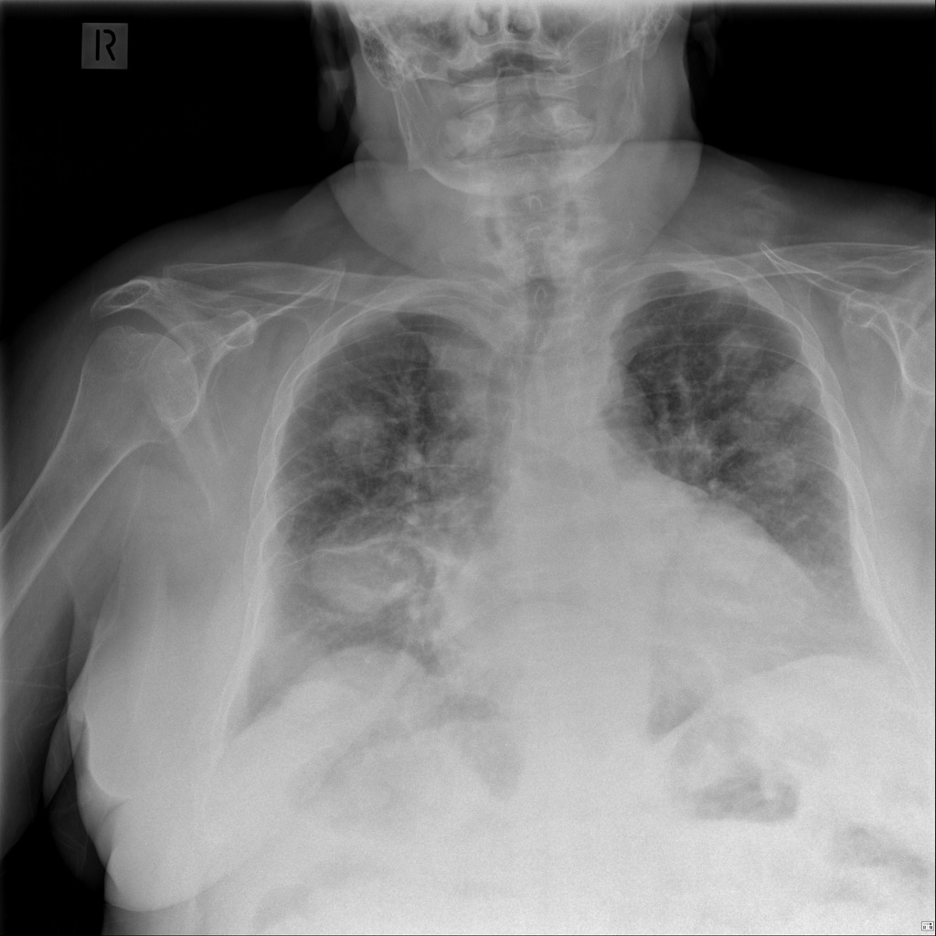 Cannonball Metastases From Endometrial Cancer Radiology Case Radiopaedia Org