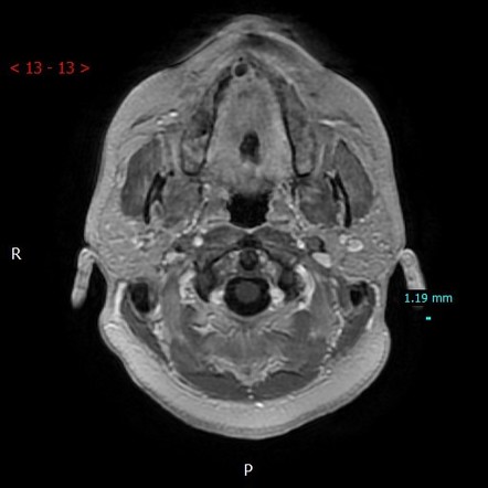 Nasopalatine duct cyst | Radiology Case | Radiopaedia.org