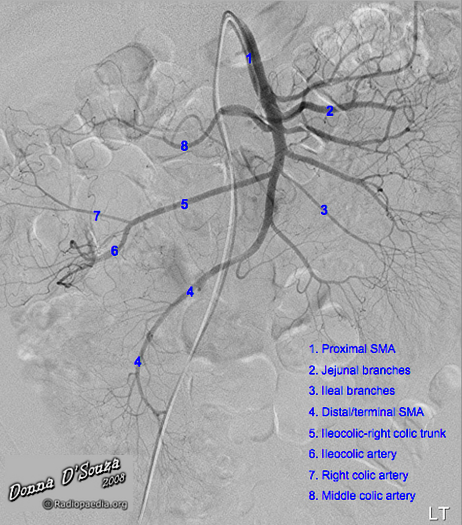 Superior Mesenteric Artery Radiology Case Radiopaedia Org