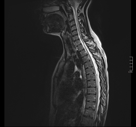 Spinal astrocytoma | Radiology Reference Article | Radiopaedia.org