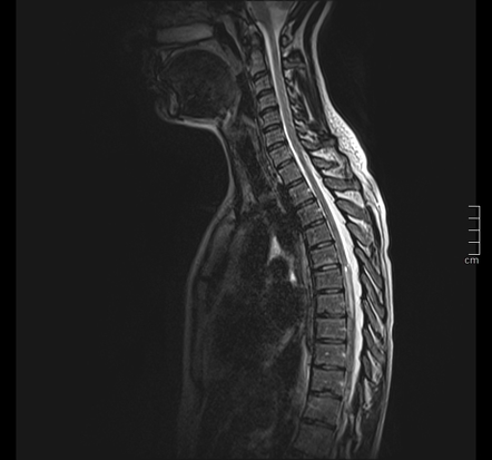 Spinal astrocytoma | Radiology Case | Radiopaedia.org