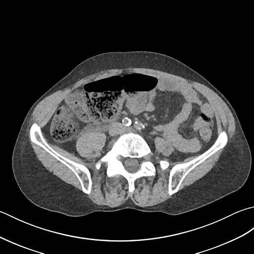 Radiolucent indinavir ureteric calculus | Image | Radiopaedia.org