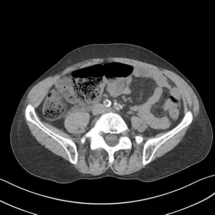 Radiolucent Indinavir Ureteric Calculus 