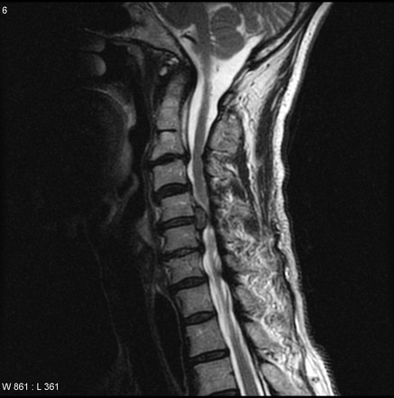 Viewing Playlist Mri Spine Radiopaedia Org