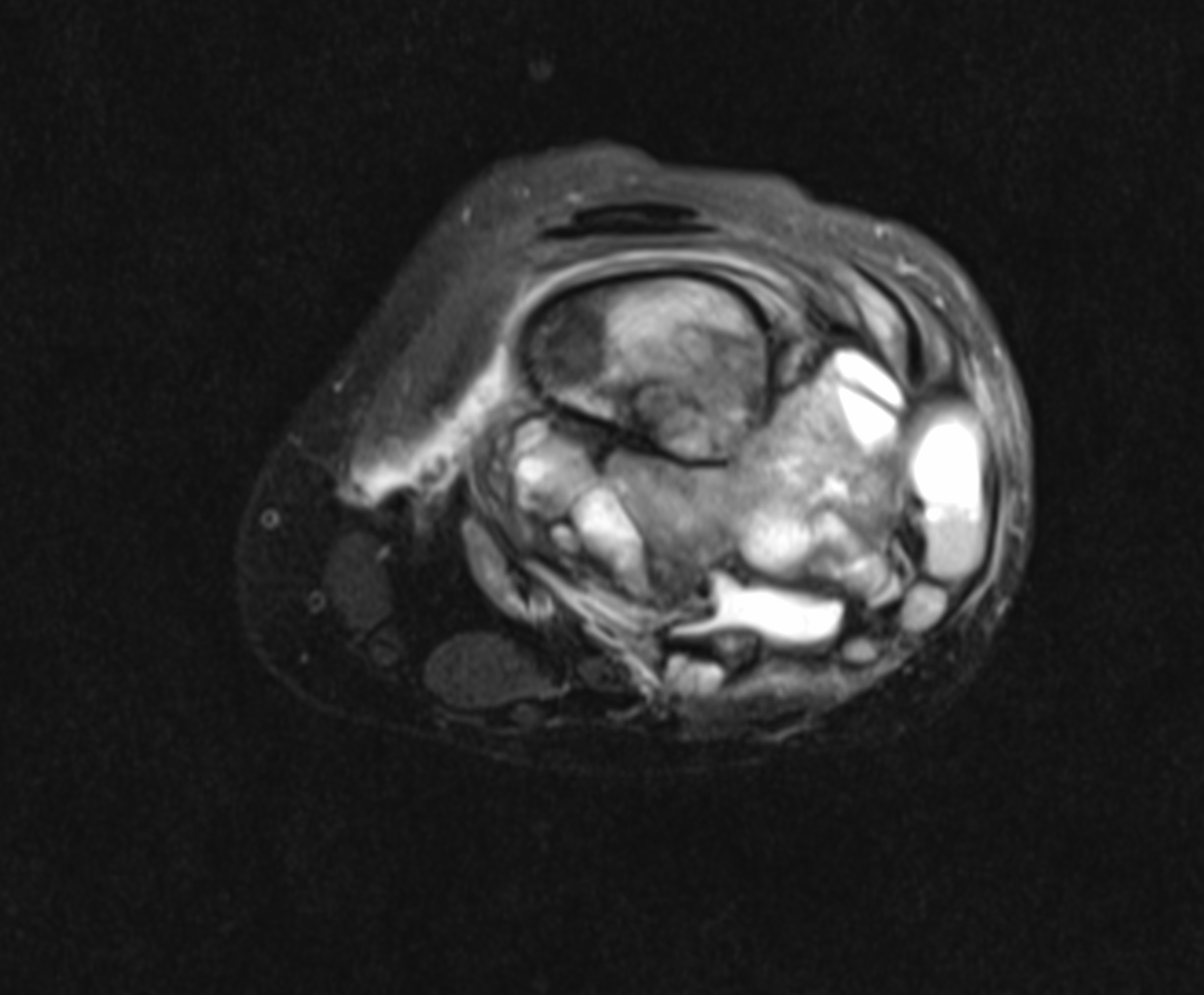 Telangiectatic osteosarcoma | Image | Radiopaedia.org