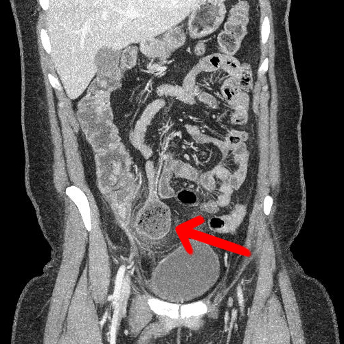 Meckel diverticulitis | Image | Radiopaedia.org