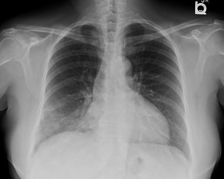 Invasive Mucinous Adenocarcinoma Radiology Case Radiopaedia Org