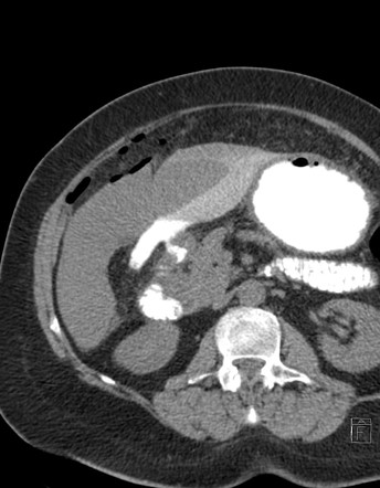 Perforated Peptic Ulcer X Ray