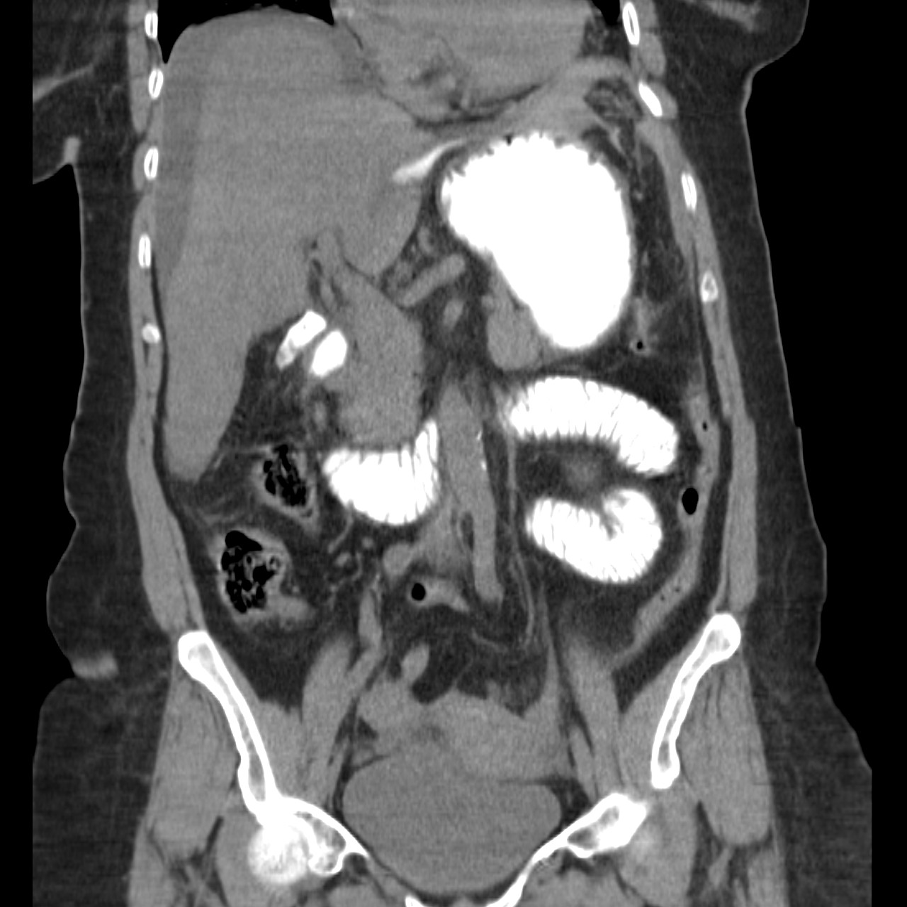 perforated-duodenal-ulcer-image-radiopaedia