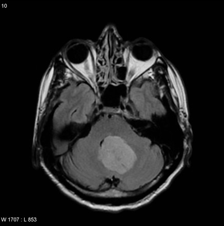 Central neurocytoma | Radiology Reference Article | Radiopaedia.org