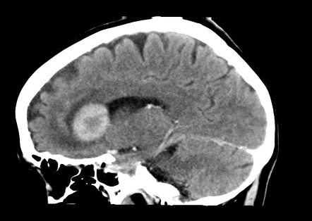 Ct Brain Sagittal Anatomy