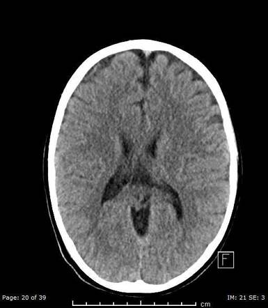 Bilateral parietal foramina | Radiology Case | Radiopaedia.org