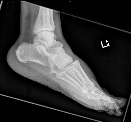 Lisfranc injury | Image | Radiopaedia.org