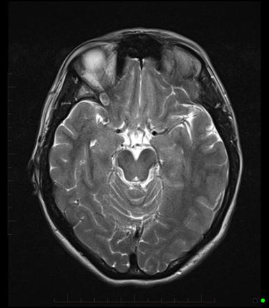 Orbital mass | Radiology Reference Article | Radiopaedia.org